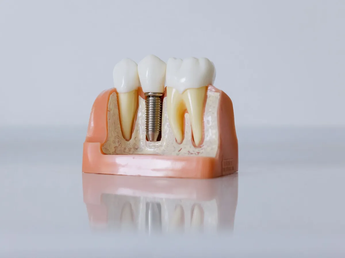 Implante dentário e enxerto ósseo