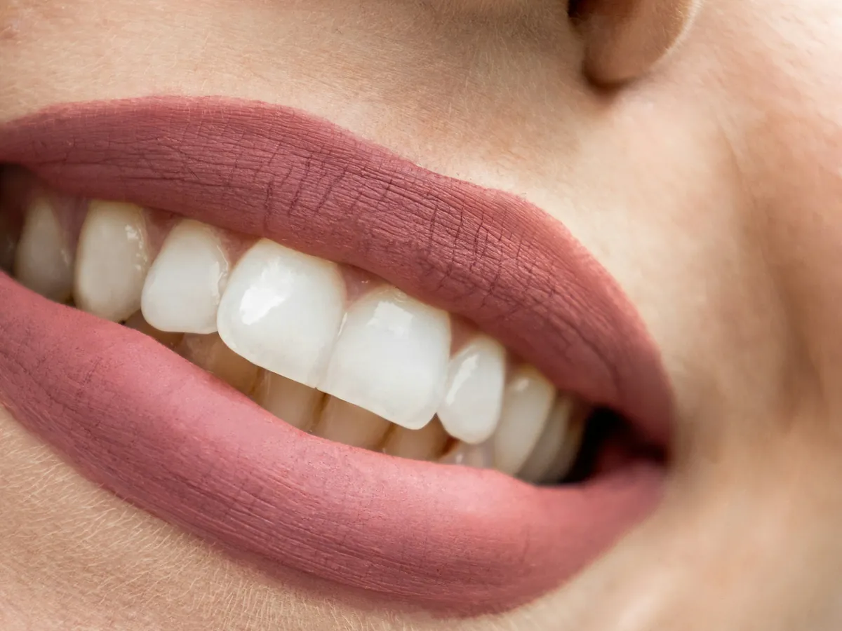 Sorriso gengival e gengivoplastia